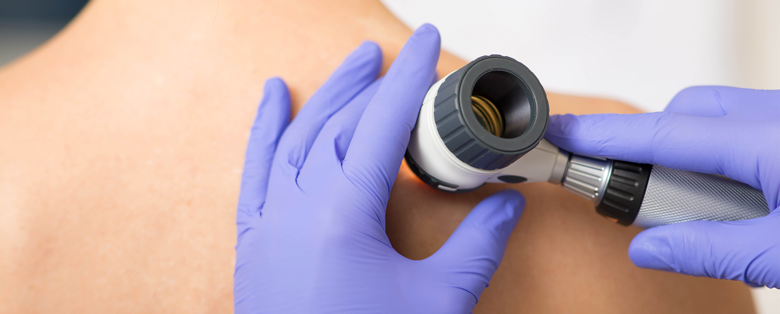 Doctor examining the skin on a patient's back with a magnifying tool