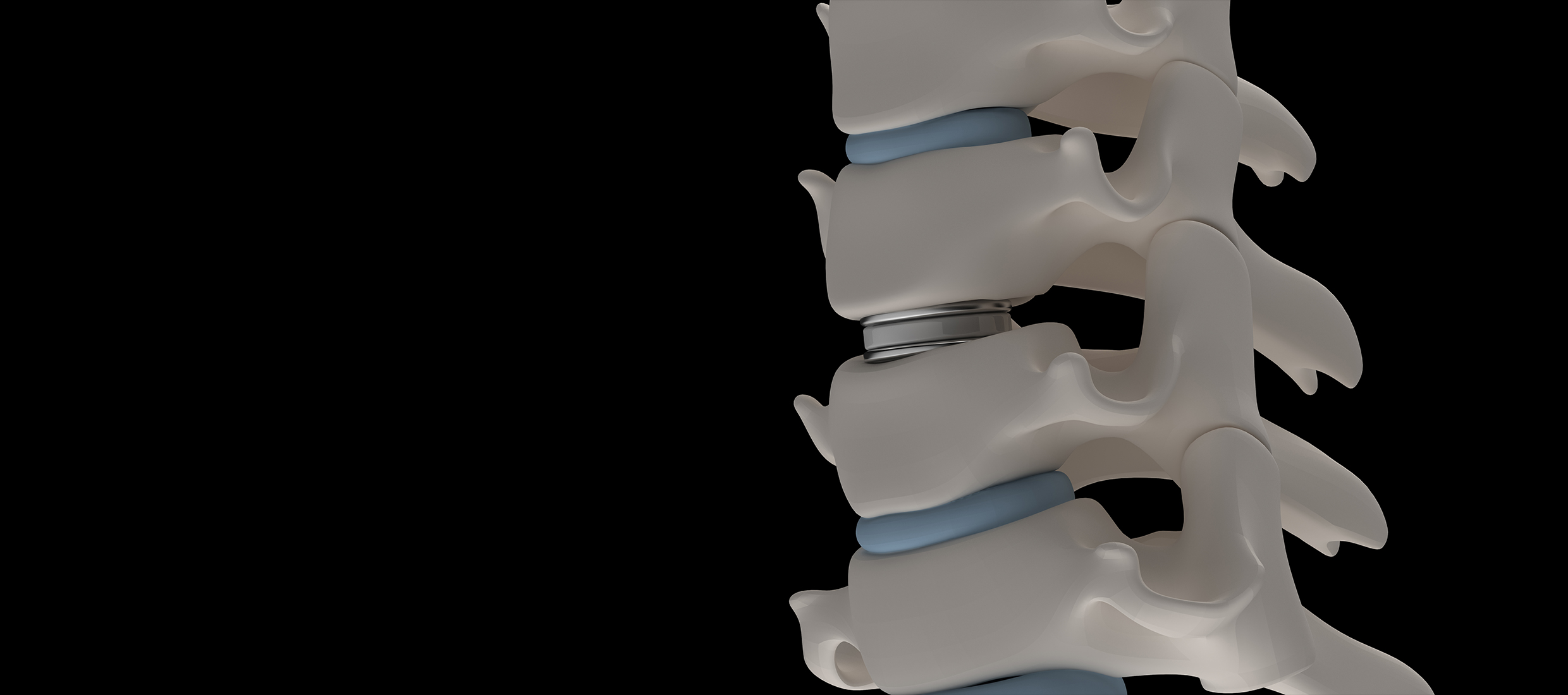 A model of a spine with degenerative disc disease is against a black background