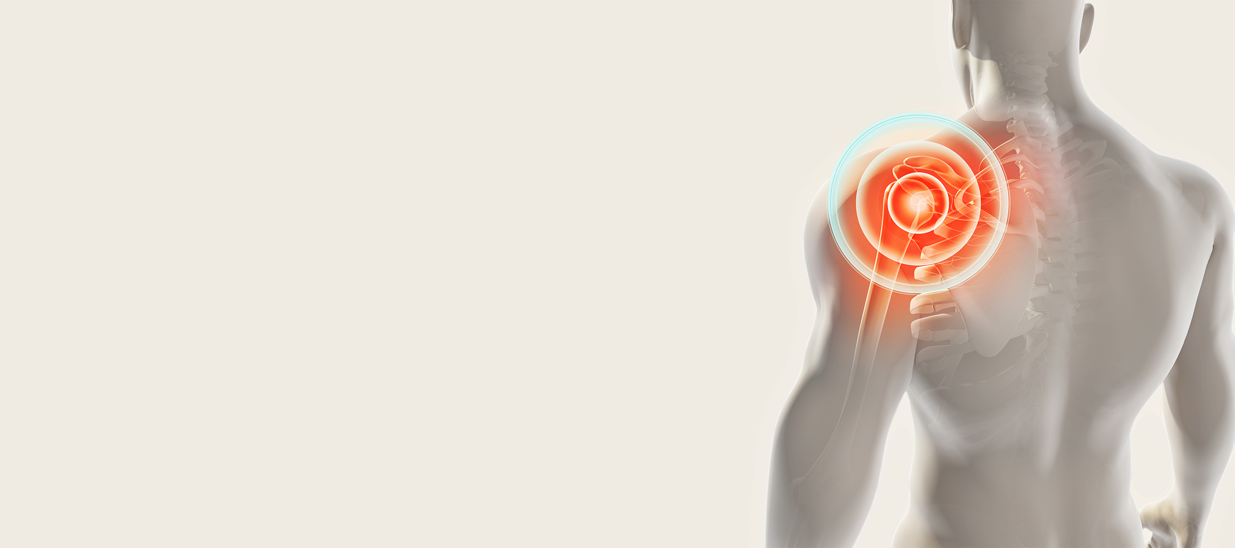 The back of a man's left shoulder has orange concentric circles showing a rotator cuff tear