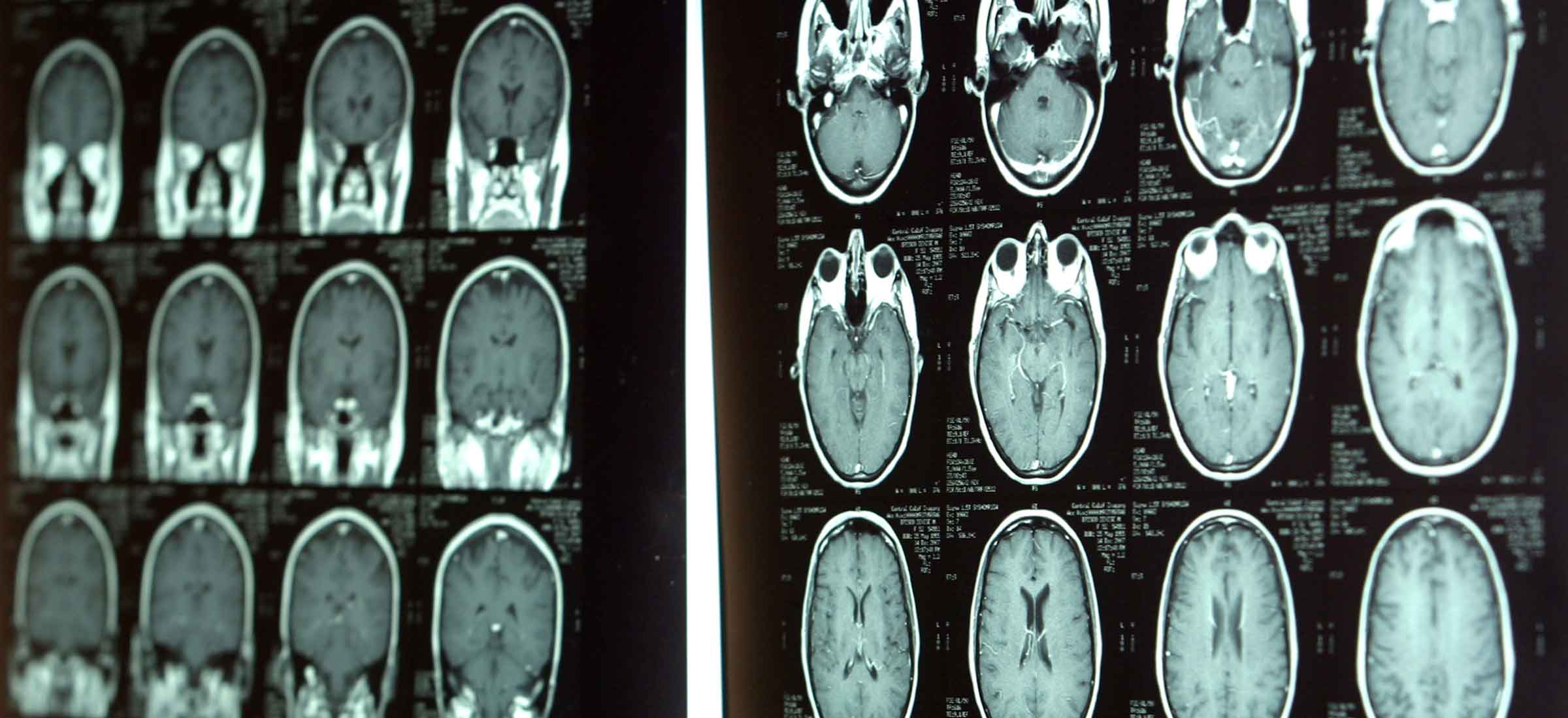 Two panels of X-rays of the skull base are displayed with data.
