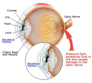 closed angle glaucoma vs open angle