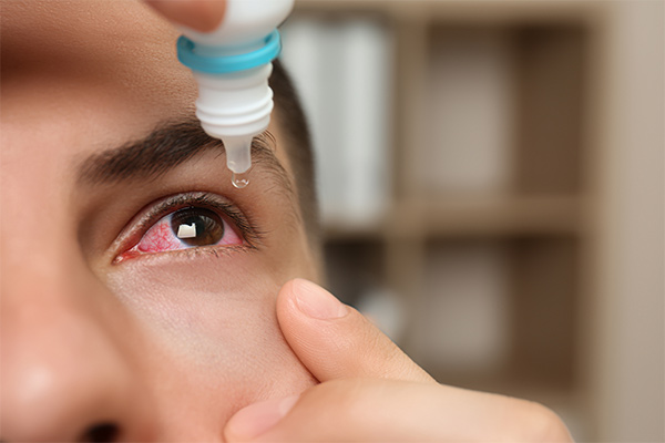 A person puts eye drops into their red eye.