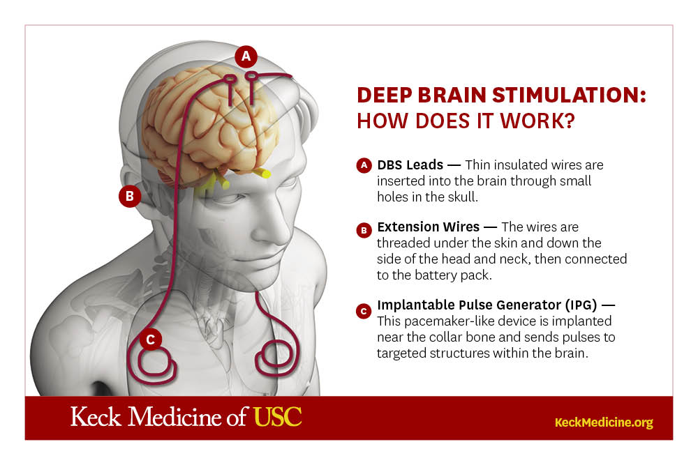 What Is Deep Brain Stimulation Keck Medicine Of Usc What Is Deep Brain Stimulation