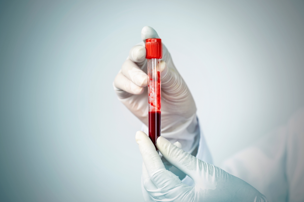 Doctor hand holding blood collection tube with sample of circulating tumor DNA as predictor for HPV-related throat cancer.