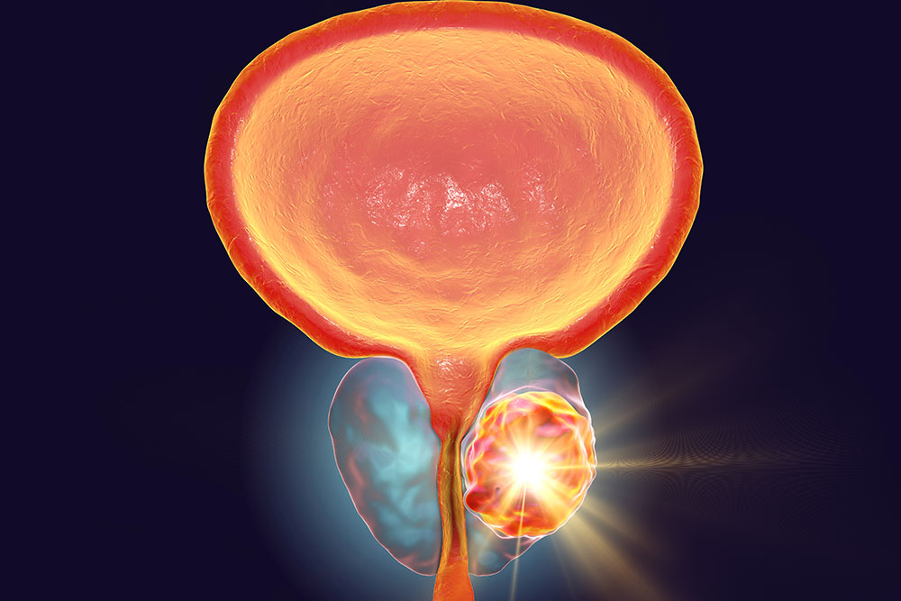 Prostate Cancer: Advances in Preserving the Prostate Gland