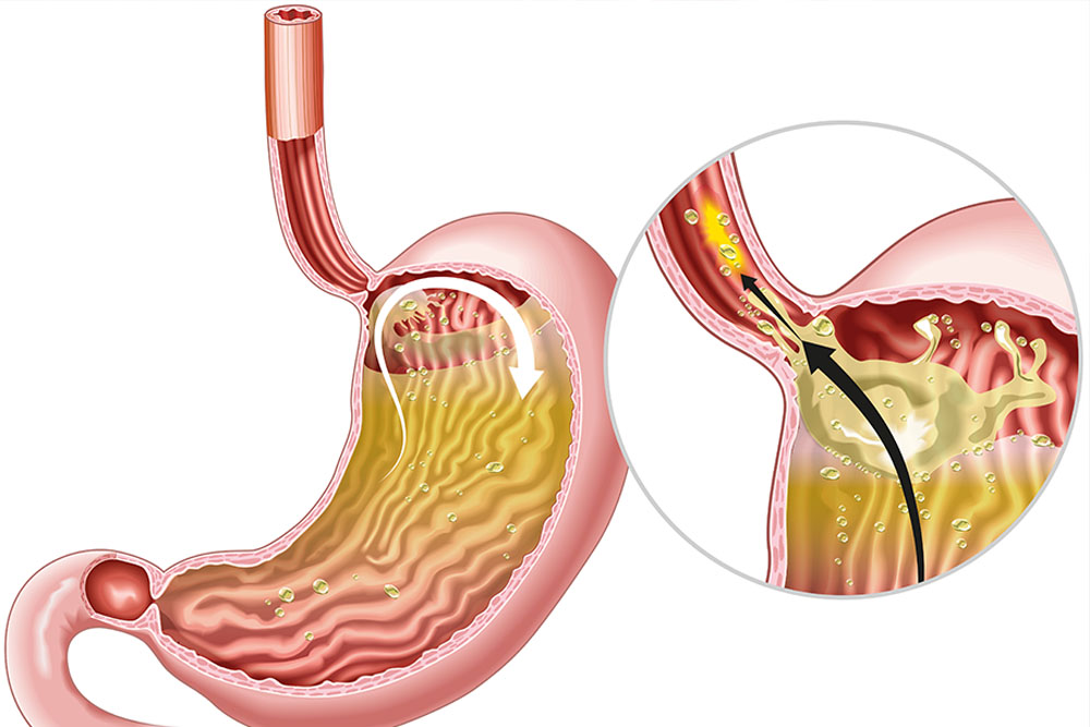 Why Patients with Chronic GERD Should Be Referred to a High-Volume Specialty Program